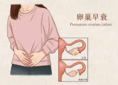 补充美国W+抗衰胶囊守护卵巢健康,警惕卵巢囊肿的侵袭